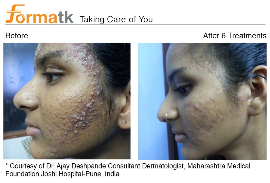 Une nouvelle étude pour traiter l'acné vulgaris La Compagnie des Lasers