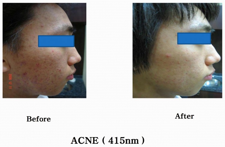 Shiny acne 1